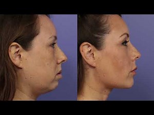 Chin Augmentation at Stoker Plastic Surgery