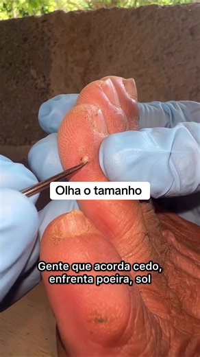 Tirando bicho de pé gigantesco #inseto #roca #bicho #de #pe