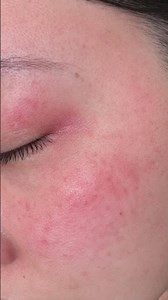 【化粧水】敏感肌用スキンケアで唯一荒れなかった化粧水を後日動画で紹介します