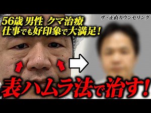 【クマ取りで若返り】50代男性の目の下のたるみを、表ハムラ法で一気に治します