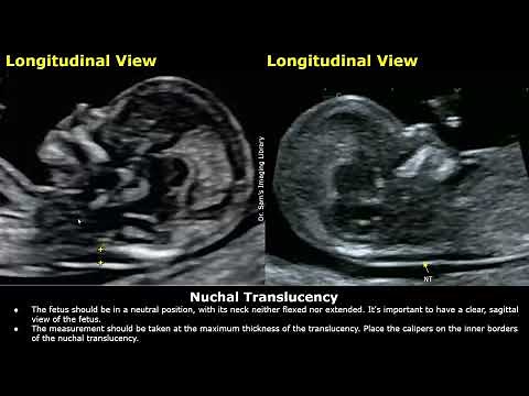 How to Measure Nuchal Translucency (NT) On Ultrasound | First Trimester NT Screening | Fetal USG