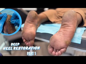 THE ULTIMATE HEEL RESTORATION + PEDICURE (PART 1) | MediPedi