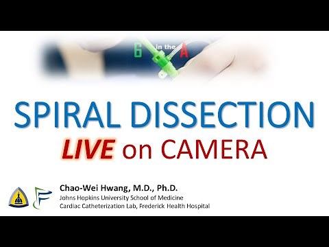 Spiral Dissection of the RCA caught on Cine