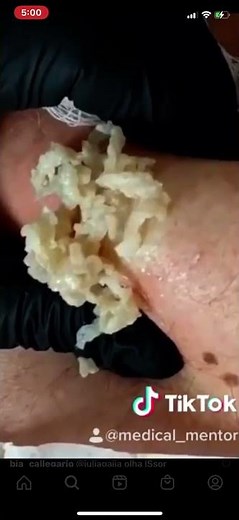 The cyst that keeps on giving