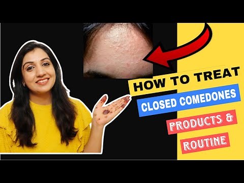 Skincare Routine for CLOSED COMEDONES|| How to treat Whiteheads, Texture, Milia? Comedones Skin