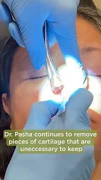 REMOVING THE NASAL CARTILAGE | Balloon Septoplasty [Part 5]