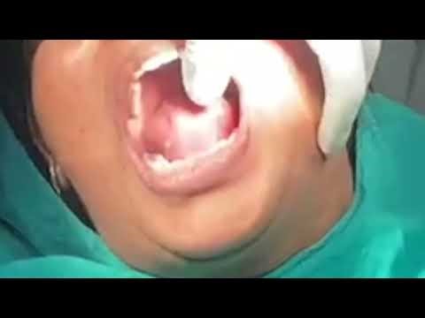 Impacted teeth removal - Dr AABU VARGHESE (MDS -ORAL AND MAXILLOFACIAL SURGERY)