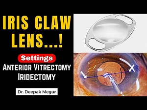 Iris Claw Lens in a case of Lens Induced Glaucoma.Using the Vitrector for Iridectomy.Dr Deepak Megur