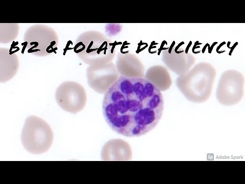 Folate (Folic Acid) & Vitamin B12 Deficiency: Macrocytic Anemia with Target Cells