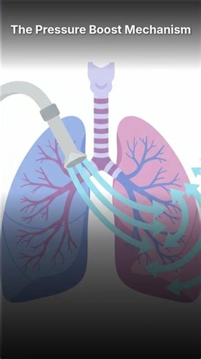 what is pressure support ventilation? #criticalcare #icu #nclexstudyguide #ventilator #nursing