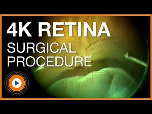 4K Ophthalmic Retina Microscopy Camera Procedure