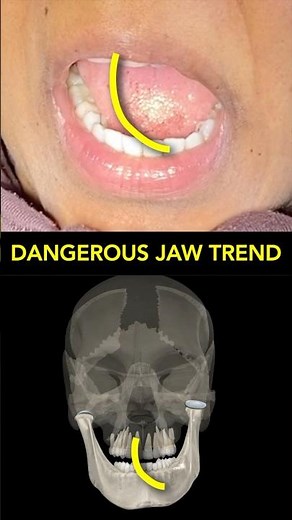 Your jaw opens like this. #tmj #jawpain #tmjdisorder