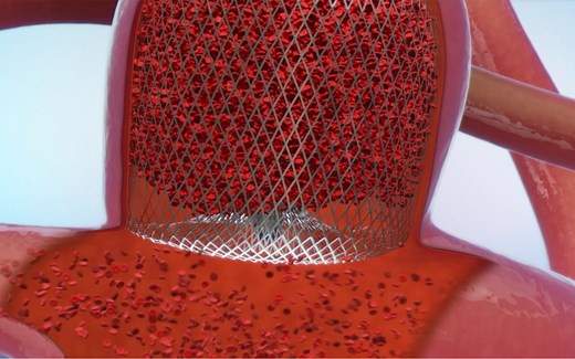 MicroVention公司开发的WEB System血管内栓塞产品