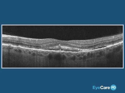 1 Retinal Pigment Epithelium (RPE)