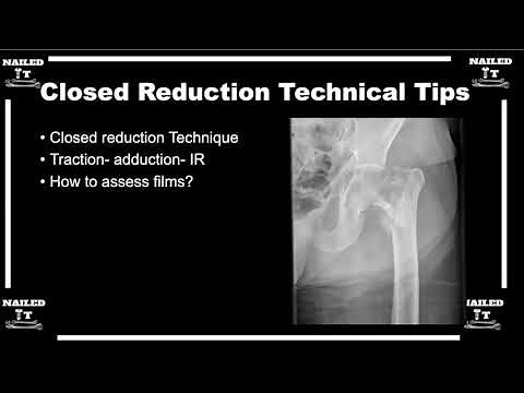 Closed reductions for intertrochanteric femur fractures