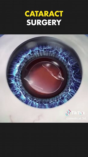 Understanding Cataract Surgery: A 3D Animation Guide