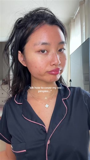 i gotchu girlies, mastered makeup so u can neva see my pimples😏 #acneproneskin #acnejourney #acnemakeup #pimples