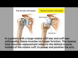 Reverse shoulder arthroplasty