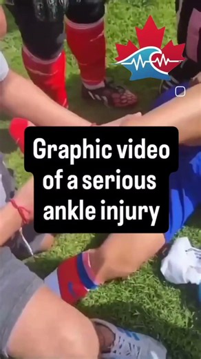Dislocated ankle