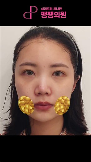 못난이 불독살 없애기? 실리프팅으로 가능! ㅣ 팽팽의원 ㅣ 팽팽클리닉
