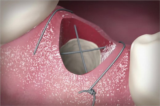 12. Criss-Cross Suture - Quintessence Publishing United Kingdom