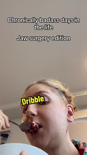 TMJ Surgery Recovery Journey: A Chronicle of Days After Jaw Surgery