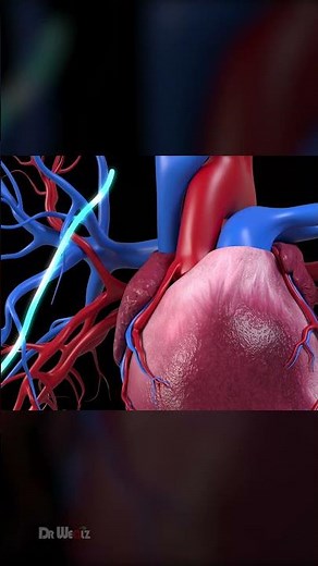 Single Heart Bypass Surgery: 3D Animation