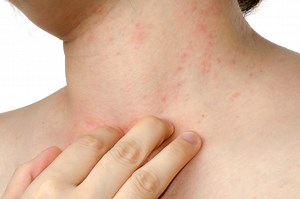 Stress dermatitis: causes, symptoms and remedies