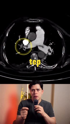 Dr. Jonah Serrano | Radiología on Instagram: "🫁 Angio-TC en Tromboembolia Pulmonar Aguda | Consenso Clínico 2025 La angio-TC es el estudio de elección para diagnosticar tromboembolia pulmonar aguda, pero no basta con ver un trombo. La calidad del estudio, la nomenclatura correcta y los hallazgos con valor pronóstico hacen la diferencia. En este video reviso los puntos clave del consenso clínico 2025 de la Sociedad Europea de Cardiología y la Sociedad Fleischner, que por primera vez estandariza 