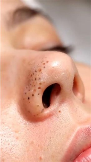 Close-Up ASMR Suction Facial — Watch Clogged Pores Transform