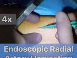 Endoscopic Radial Artery Harvesting • Video • MEDtube.net