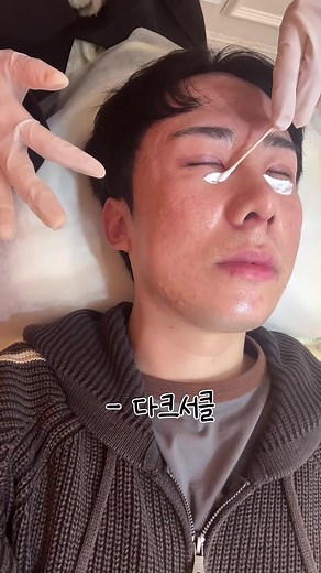 다크서클과 부종 관리 방법