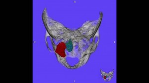 TDM 3D des sinus paranasaux montrant : vidéo de stock (100 % libre de droit) 3985793195 | Shutterstock