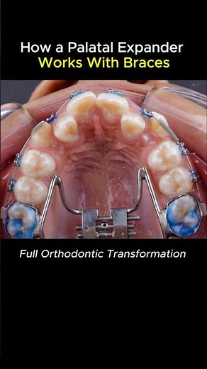 Palatak expander works with braces #braces #orthodontist #dentist #teeth #dental