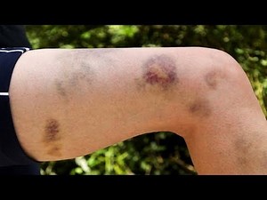 How to Get Rid of Bruises in 24 Hours.