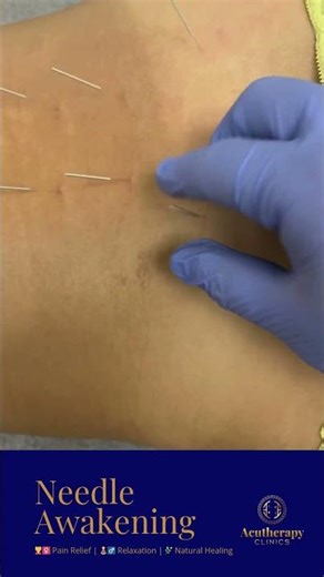 Needle Awakening|Acutherapy|Acupuncture|Massage|Cupping#healing #chinesemedicine #acupuncture#relax