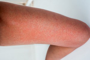 Allergie au soleil : photo, combien de temps ça dure ?