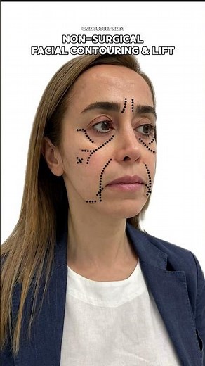 Facial Contouring with Neustem™ treatment