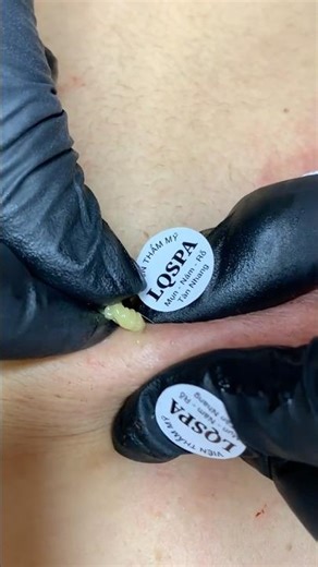 Acne Extraction | Deep Pimple Cleaning from Face🫣🫣🫣