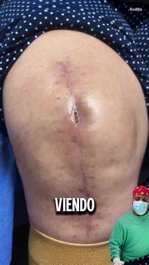 Cirugía de rodilla #ortopedia