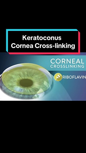 Understanding Keratoconus and Cornea Cross-linking Procedures