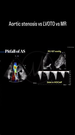 #AS versus #LVOTO verus #MR in #echocardiography - how to differentiate signals