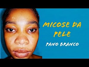 Como me livrei e acabei com o pano branco *micose* em 4 semanas