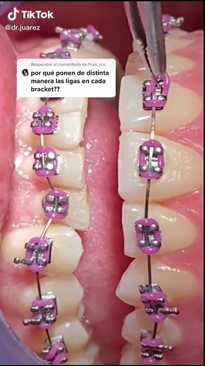 Poniendo Ligas en Brackets: Paso a Paso