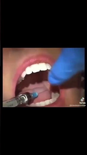 mandibular nerve block anesthesia #dentist