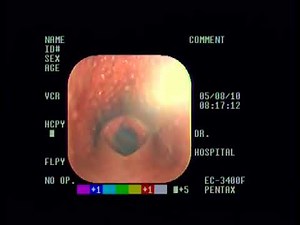 Dorsal Displacement of the Soft Palate