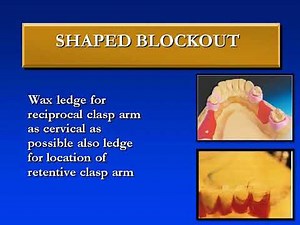 laboratory procedures for removable partial denture