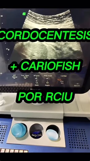 Unifetal - Perinatología on Instagram: "CORDOCENTESIS + CARIOFISH POR RCIU. #cordocentesis #unifetal #embarazo #perinatologo #maternofetal #ecografia #barranquilla #valledupar"