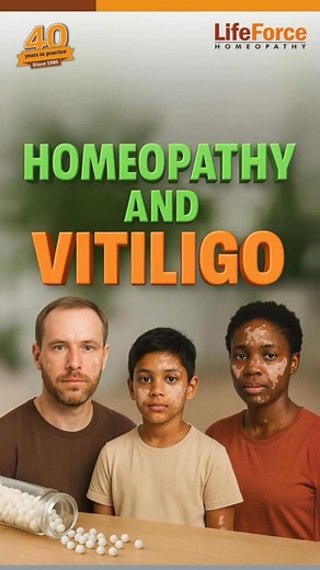 Can Homeopathy Help in Vitiligo? Yes, it can — and it’s backed by decades of clinical experience. In this video, Dr. Rajesh Shah, MD (Homeopathy) & Director of Life Force Homeopathy, shares valuable insights on how homeopathy offers a scientific and effective treatment for chronic skin conditions like Vitiligo. ✅ Safe for long-term use ✅ Treats the root cause, not just the symptoms ✅ Thousands of patients treated globally 🎥 Watch now to discover a holistic solution to Vitiligo — beyond just ext