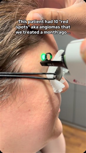 Dr. Omar A. Ibrahimi | Angiomas are benign but can easily be treated with a pulse dye laser. #dermatologist #dermatology #skincare #skin #angioma | Instagram